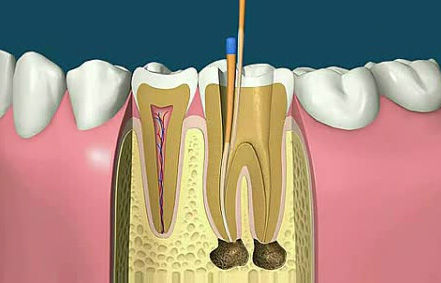 根管治疗牙周病