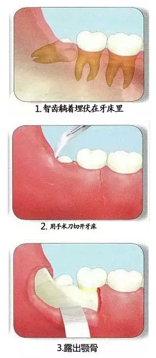 智齿拔除的过程步骤图片