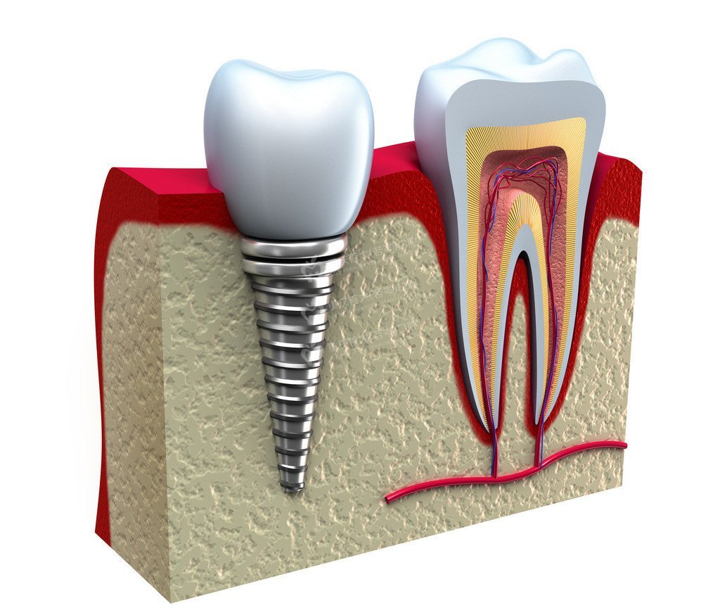 多颗牙齿种植牙的6项护理原则