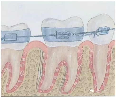 牙齿矫正过程图解