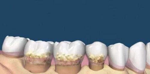 为什么要洗牙,洗牙的好处,洗牙,洗牙的过程,洗牙后的注意事项