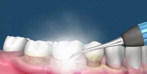 为什么要洗牙,洗牙的好处,洗牙,洗牙的过程,洗牙后的注意事项