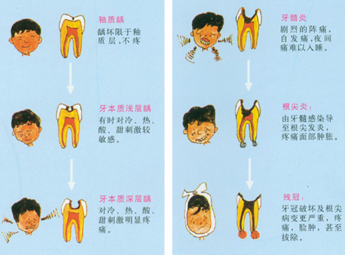  深圳儿童龋齿补一颗牙多少钱？