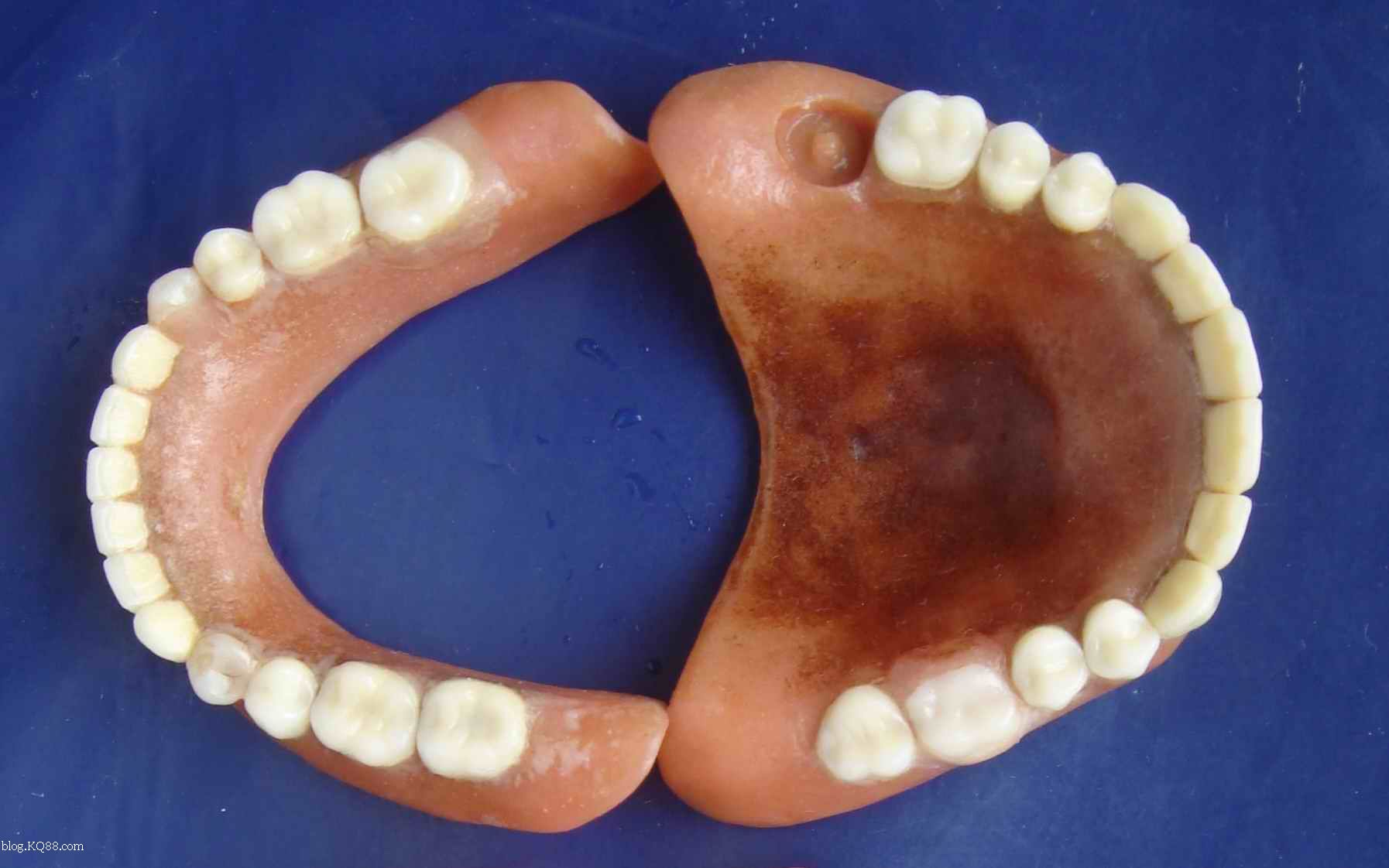 全口牙缺失，活动义齿修复 - 知乎