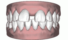 补牙缝过程图解
