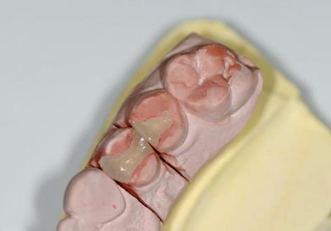 嵌体补牙的优缺点是什么
