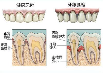 首页 牙周治疗 牙周炎    牙龈萎缩的情况如果不及时治疗,会出现牙根