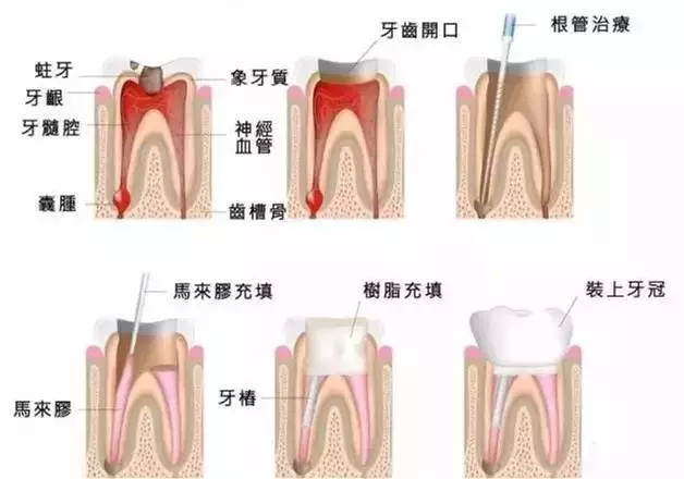 根管治疗后牙齿能用几年