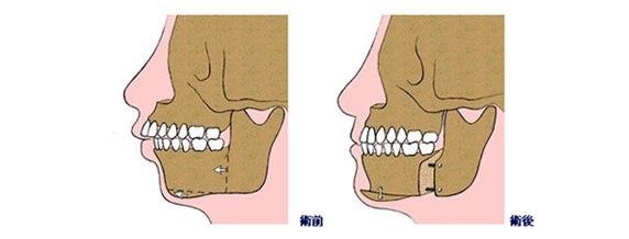 牙齿外突矫正方式