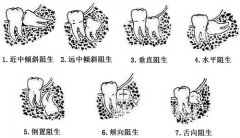 智齿有哪些类型?常见的几种智齿