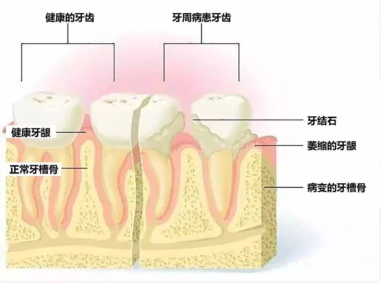 了解牙龈疾病，请重视口腔卫生！