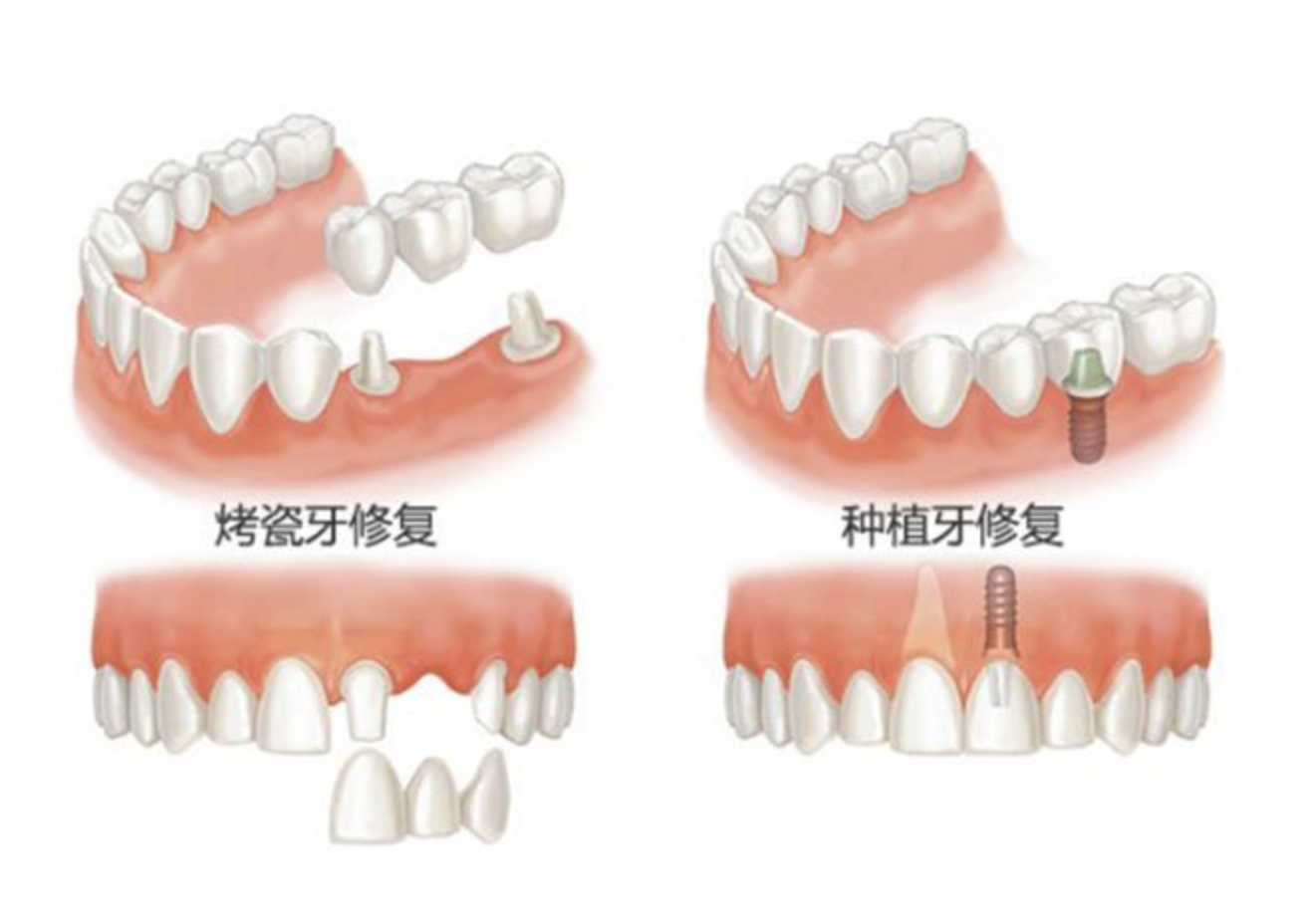 镶牙和种牙有什么区别？ - 知乎