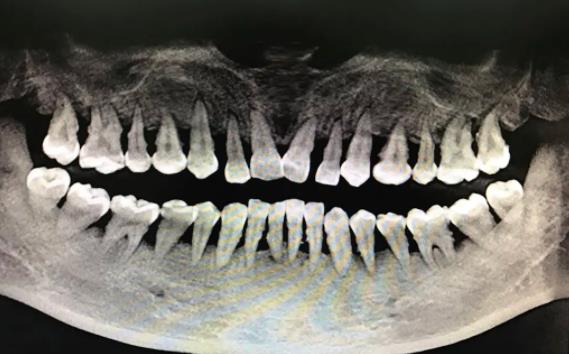 牙槽骨萎缩