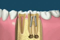 桩核冠是怎么安装到牙齿里面的