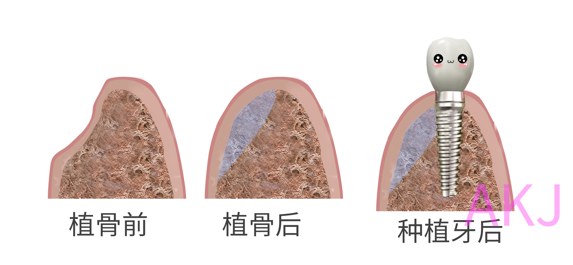 牙齿缺失是什么原因导致的呢——广州德伦口腔