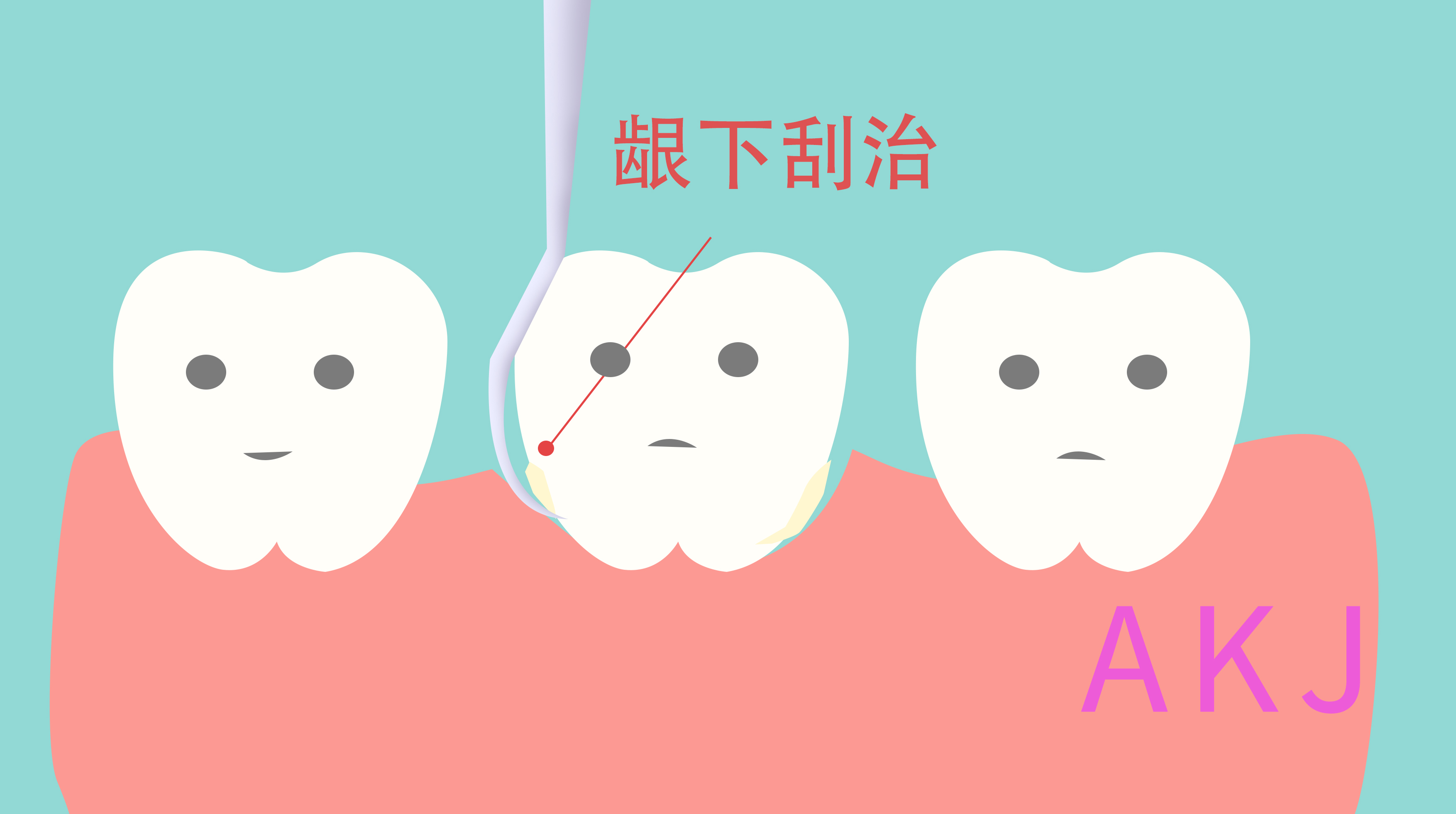牙周炎治疗的龈下刮治和普通洗牙有何异同？ - 知乎