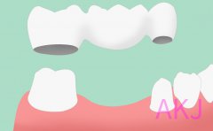 做固定义齿的牙套是什么样的