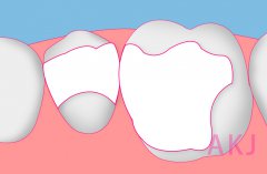 牙齿修复有几种方法？这次终于分清了