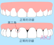 关于黑三角：牙齿矫正会导致黑三角？