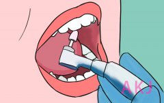 牙医：定期洗牙真的有必要！
