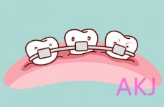 矫正后的牙齿为什么会复发？哪些情况需要二次矫正？