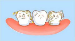 氟斑牙如何治疗？控制氟化物摄入量的建议