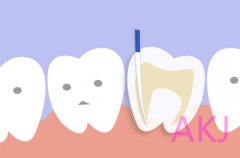 深圳一颗牙做根管治疗要多少钱？看牙去哪个牙科诊所？