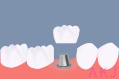爱康健口腔种植牙：半口牙缺失能做种植牙吗？