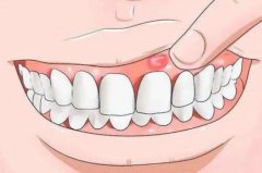 牙龈发炎肿痛？口腔卫生习惯是关键！